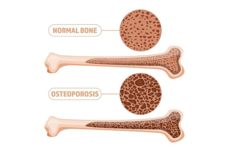 osteoporosis