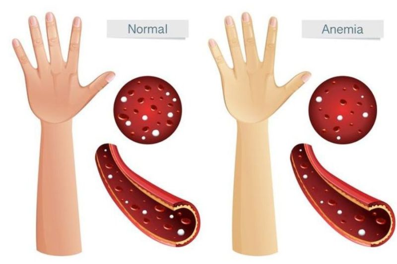 ilustrasi anemia