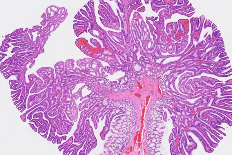 Pengertian Adenoma