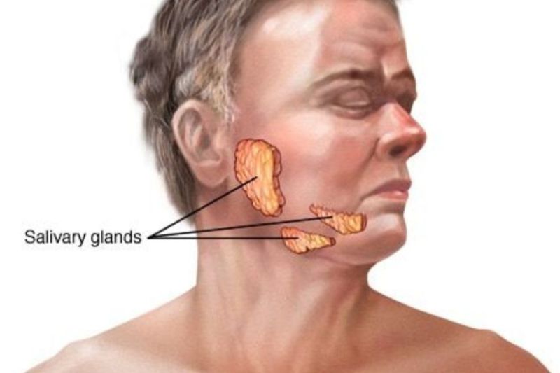 Sindrom Sjogren