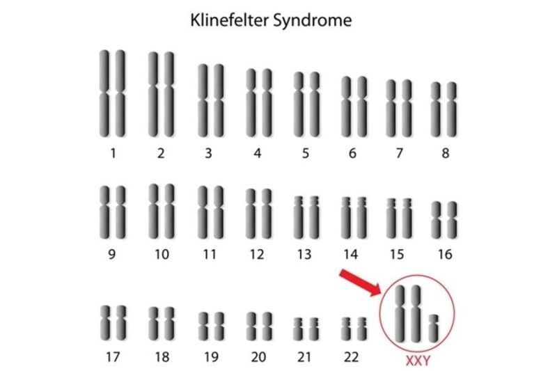 Sindrom Klinefelter