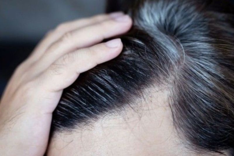 4 Cara Mengatasi Masalah Uban alami bagi Rambut Hitam Sehat