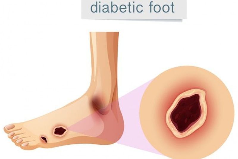 Bahaya Luka Kaki pada Penderita Diabetes: Kenali "Diabetic Foot" Lebih Awal