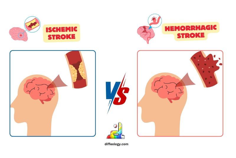 Perbedaan Stroke Iskemik dan Hemoragik, Mana yang Lebih Bahaya?