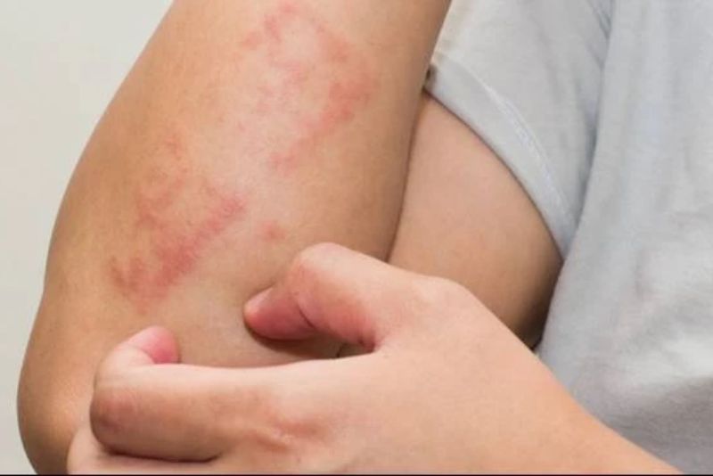Pernah Dengar Steven Johnson Syndrome? Ini yang Perlu Kamu Tahu!