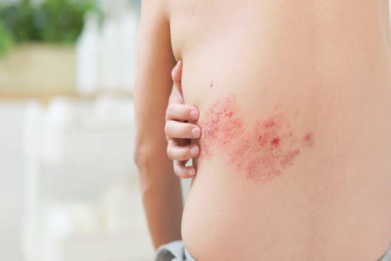 Cacar Api Bisa Kambuh Setelah Cacar Air: Fakta Mengejutkan tentang Herpes Zoster yang Sering Diabaikan