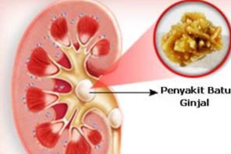 Batu Ginjal: Waspadai 5 Kebiasaan Sehari-hari Ini!