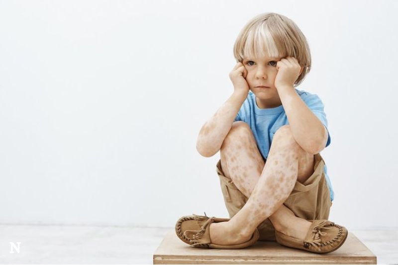 Meningkatkan Kesadaran tentang Vitiligo: Langkah C Derma Menghadapi Stigma Sosial