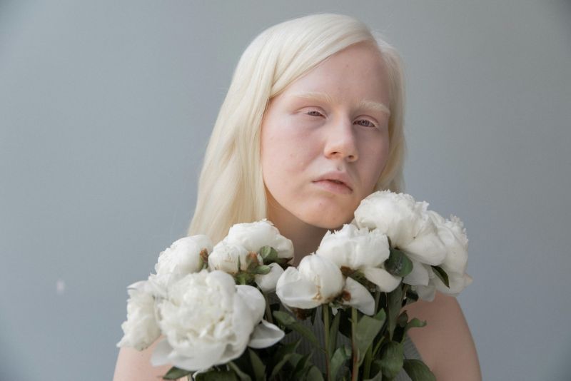 Albino