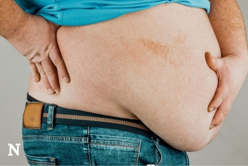 Dokter: Obesitas Bisa Mempercepat Penuaan, Perlu Penanganan Menyeluruh