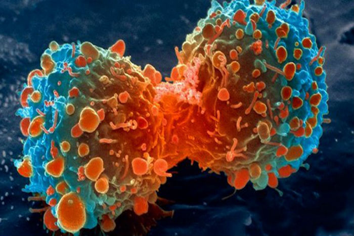 Kanker Payudara pada Pria: Gejala, Penyebab, dan Pengobatan