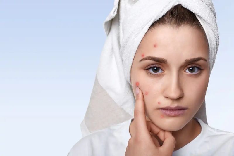Mengenal Lebih Jauh Perawatan Chemical Peel untuk Mempercantik Kulit Wajah