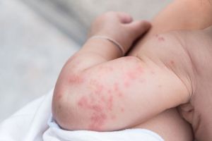 Penanganan Reaksi Alergi pada Bayi