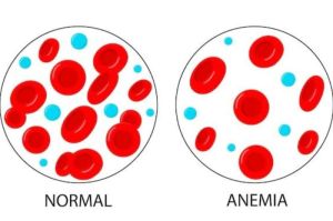 ilustrasi anemia