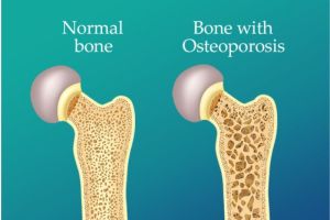 Osteoporosis