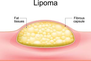 Penyakit Lipoma: Penyebab, Gejala, dan Pengobatan