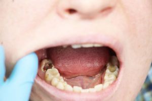 Bahaya Karies Gigi dan Cara Pencegahannya