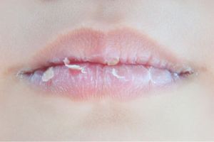Bibir Pecah-pecah