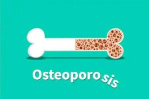 Cara Mencegah Osteoporosis