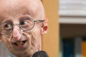 Apa Itu Progeria, Penyakit Langka Penyebab Sammy Basso Meninggal