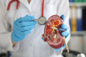 Gejala batu ginjal yang terlihat pada urine.(iStockphoto/Ivan-balvan)