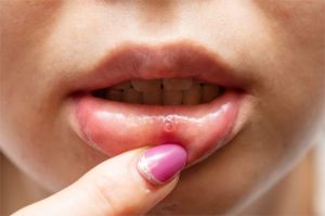 ilustrasi seseorang dengan sariawan di bibir dan merasa tidak nyaman