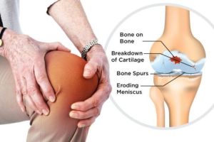 Radang Sendi/Osteoartritis: Penyebab, Gejala, Pengobatan