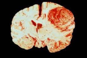 Penyebab Glioblastoma Menyerang Otak