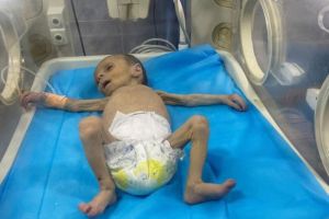 Pedihnya Bayi 2 Bulan di Gaza Berjuang Melawan Gizi Buruk